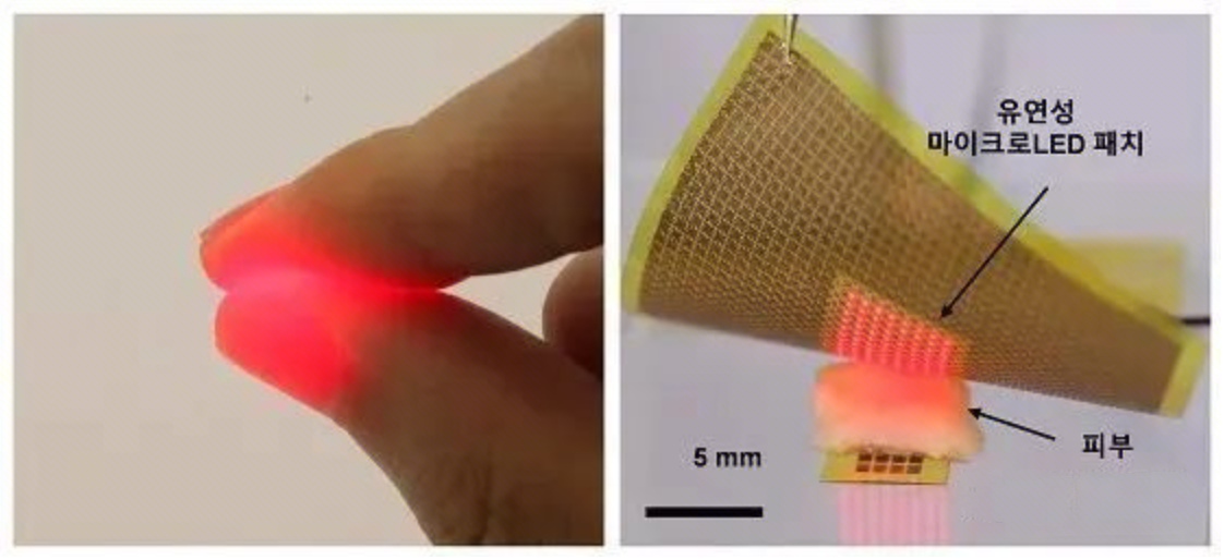 LED 패치가 있는 피하 마이크로 태양 전지: 지속적인 건강 관리 모니터링을 위한 무선 전력 이식형 센서 